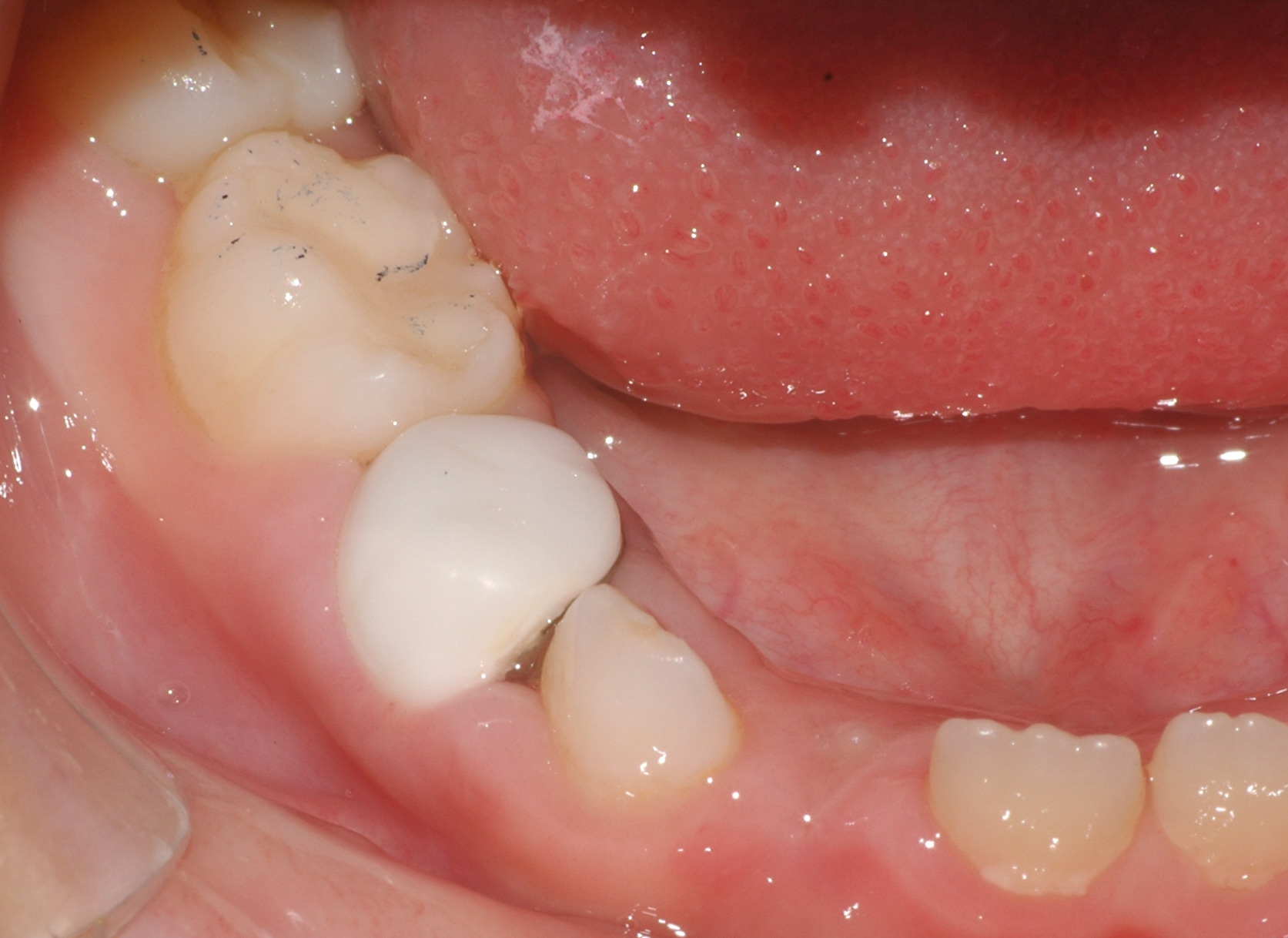 关于乳牙早失和如何有效保持乳牙间隙的问题？ - 知乎